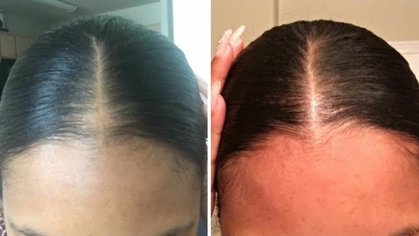 Home Remedies for Hair Fall: How to Support Natural Hair Growth on Bald Patches